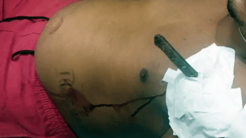 Homem de 24 anos é ferido com faca durante tentativa de homicídio em Gongogi